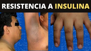 RESISTENCIA A LA INSULINA  ¿Qué le hace a tu cuerpo [upl. by Hassin]