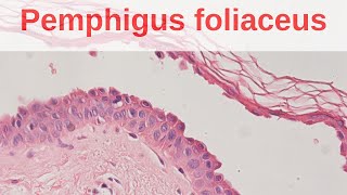 Pemphigus Foliaceus  Pathology mini tutorial [upl. by Reinnej]