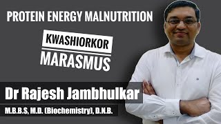 PROTEIN ENERGY MALNUTRITION PEM Kwashiorkor and Marasmus [upl. by Enimsaj952]