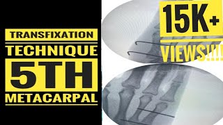 5th Metacarpal Fracture Transfixation technique [upl. by Sewole]