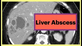 Liver Abscess Radiology Radiology Liver Surgery [upl. by Lorenzo]