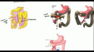 Gut Malrotation Nonrotation and Volvulus for USMLE [upl. by Acinhoj]