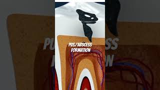 How Pus Abscess is formed in your tooth education pus abscess babymonster likethatchallenge [upl. by Shedd]