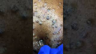 Removing large blackheads and pimples from face new 2021 23 [upl. by Rebma]