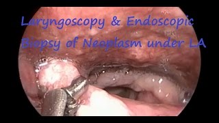 Laryngoscopy amp Endoscopic Biopsy of Neoplasm under LA [upl. by Gillead]