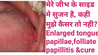 मेरे जीभ के साइड मे सुजन है कही मुझे कैसर तो नहीEnlarged tongue papillaefolliate papillitis ampcure [upl. by Aihsercal]