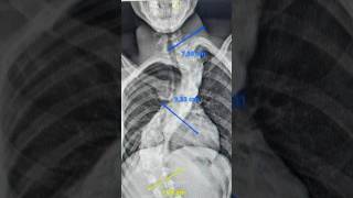 MY SCOLIOSIS BACK SURGERY [upl. by Blinny]