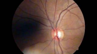 Optic Disc  Spontaneous Venous Pulsations [upl. by Arbmik]