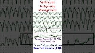 Ventricular Tachycardia Management [upl. by Eeslek453]