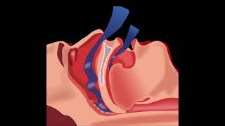 Apnée du sommeil Tout savoir sur l’apnée obstructive du sommeil [upl. by Ainigriv]