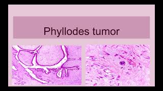 Phyllodes Tumor of Breast [upl. by Llenrahs]