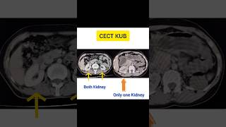 Left Kidney Absent [upl. by Akcirderf677]