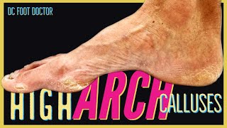 High Arch Calluses Treating Very High Rigid Aches and Thick Calluses [upl. by Alber]