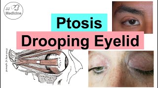 Ptosis Drooping Eyelid  Eye Anatomy Causes Associated Conditions Diagnosis amp Treatment [upl. by Noslen]