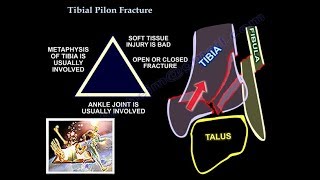 Tibial Pilon Fracture  Everything You Need To Know  Dr Nabil Ebraheim [upl. by Ttennej344]