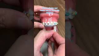 Easier Way to Floss with Braces  Platypus Floss [upl. by Sergius]