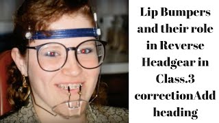 Lip Bumpers and their role in Reverse Headgear in Class3 correction [upl. by Fishback133]