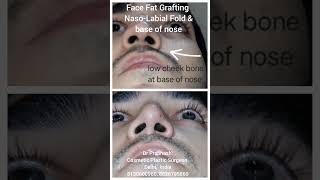 Face Nose Cheek Fat Grafting Asymmetry Correction in Delhi fatgraftingsurgery  nose  nosetip [upl. by Celesta]