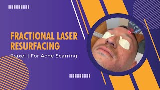 Fractional Laser Resurfacing  Fraxel  For Acne Scarring  Dr Jason Emer [upl. by Malin]