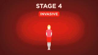 Beyond The Shock  Chapter 5  Types amp Stages  Stage 4 Breast Cancer [upl. by Ruby876]