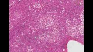 Histopathology Liver Alcoholic liver disease [upl. by Inama]