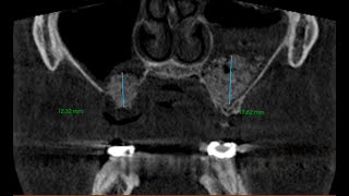 Sinus Lift Augmenation  Lateral Wall Approach  A Debrief [upl. by Nev]