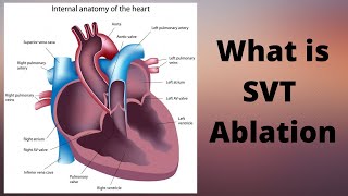 What is SVT Ablation [upl. by Cutlor]