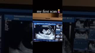 Ultrasound scan baby movement in womb pregnancycare pregnancy ultrasound [upl. by Tol912]