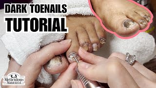 Why do Toenails turn Black nails satisfying [upl. by Edya]