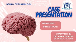 is it really papilloedema ✌🤞👌 Dr Reem Fawzy [upl. by Cotsen]