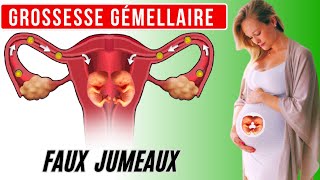 Grossesse gémellaire mécanisme de formation des faux jumeaux [upl. by Omora]