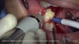 PIEZOSURGERY®  Dr Roberta Grassi Extraction of Impacted Third Molar with Piezo Levers [upl. by Ahsieket127]