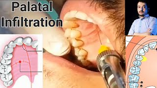 Local Anesthesia Palatal Infiltration Technique Maxillary Anesthesia Techniques dentistry [upl. by Ennairod]