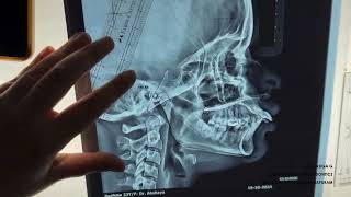 Demostration on Jarabaks Cephalometric Analysis  DrRasiga Gandhi  Department of Orthodontics [upl. by Aleicarg]