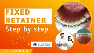 Fixed Retainer placing step by step process  Permanent Retainer  Chhabrani Dental Clinic  Dentist [upl. by Elesig493]