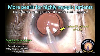 CataractCoach 1628 more pearls for highly myopic patients [upl. by Viglione]