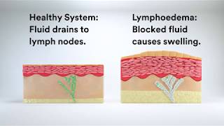 Managing Lymphoedema with Compression Therapy [upl. by Romona930]