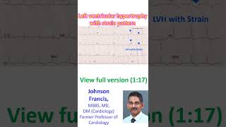 Left ventricular hypertrophy with strain pattern [upl. by Cello]