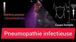 Pneumopathie Consolidation Échographie pulmonaire [upl. by Ativla]