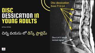 Disc Degeneration L5 S1 Disc Desiccation Disc Degeneration Causes DDDDegenerative Disc Treatment [upl. by Nesyaj858]