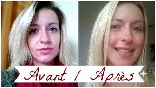 ACNE ❀ Roacutane mois après mois [upl. by Ihel]