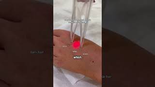 How laser hair treatment works [upl. by Yerac111]