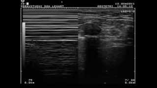 Pneumothorax  lung point sign [upl. by Aneled]