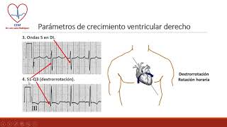 Crecimiento ventricular derecho [upl. by Elorac]