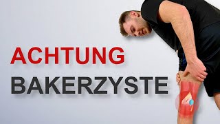 Bakerzyste  Das musst du wissen [upl. by Undine]