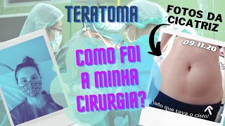 Relato de cirurgia Retirada do cisto e ovário com fotos da cicatriz [upl. by Yregram]