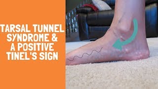 Tarsal Tunnel Syndrome with a Positive Tinels Sign [upl. by Rosel]