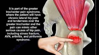 Gluteus Medius Tendon Tear  Everything You Need To Know  Dr Nabil Ebraheim [upl. by Allain624]