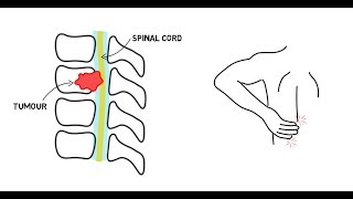 Spinal Cord Compression [upl. by Tolman735]