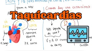 FISIOPATOLOGÍA de las ARRITMIAS con sus TRATAMIENTOS [upl. by Hinkle]